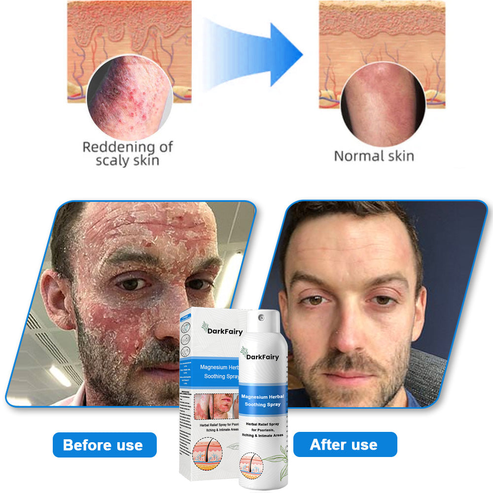 ✅ Official Store: QIAWI Magnesium Herbal Psoriasis Spray 👨‍⚕️MHRA Approved | Relieves psoriasis & eczema, improves genital bacterial infections, treats acne & warts