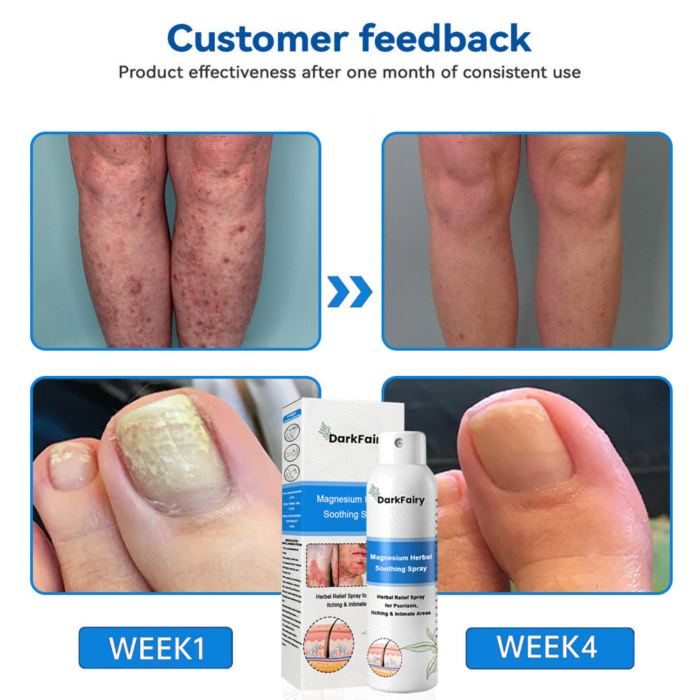 ✅ Official Store: QIAWI Magnesium Herbal Psoriasis Spray 👨‍⚕️MHRA Approved | Relieves psoriasis & eczema, improves genital bacterial infections, treats acne & warts